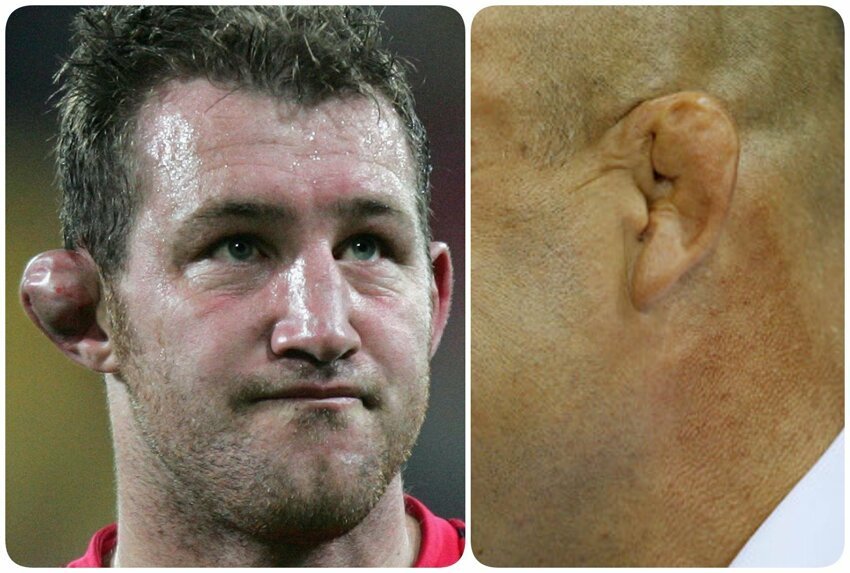 2. В вольной борьбе (и в регби) отличительной травмой являются сломанные уши
