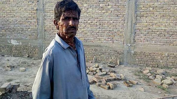 Покрытый опухолями пакистанец вынужден жить, как отшельник