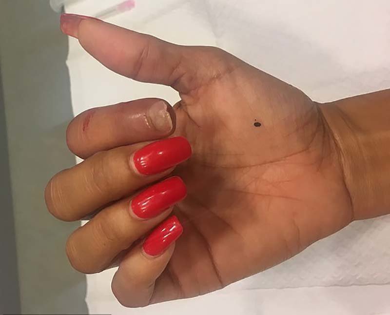 Женщине из США удалось нарастить палец, который ранее ей откусила пума