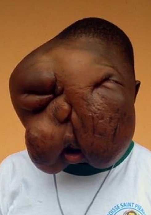 Подростку из Африки удалили гигантскую лицевую опухоль