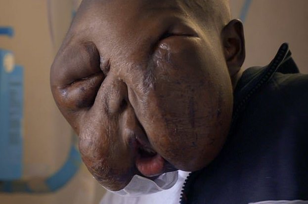 Подростку из Африки удалили гигантскую лицевую опухоль