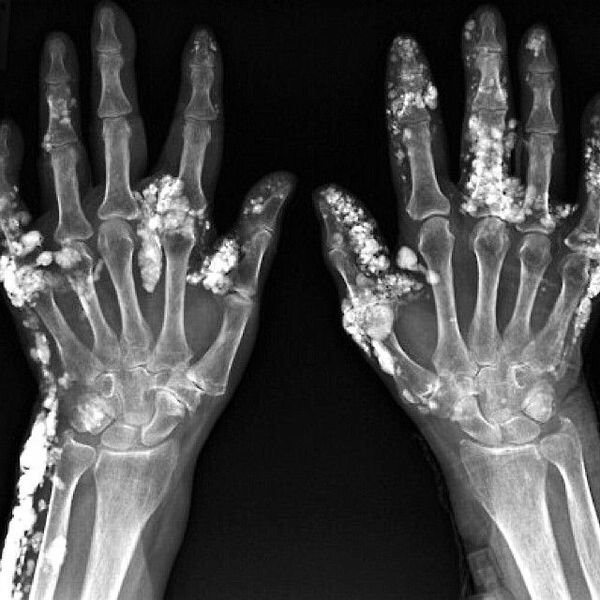 1. Рентген человека с кальцинозом кожи