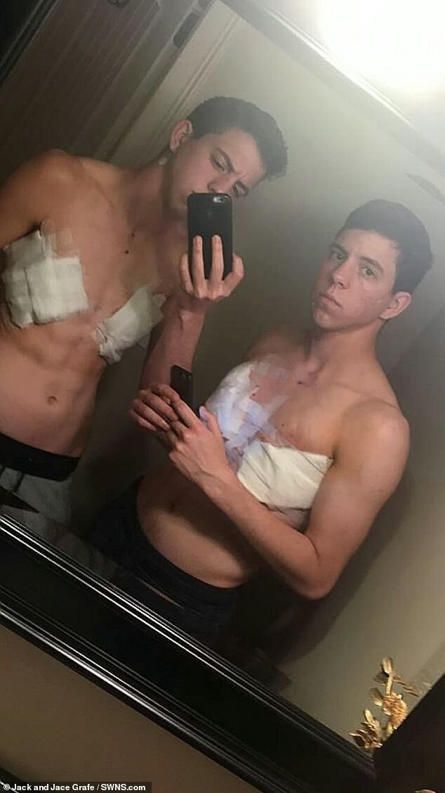 Джек (слева) и Джейс после операции в августе 2018 г.