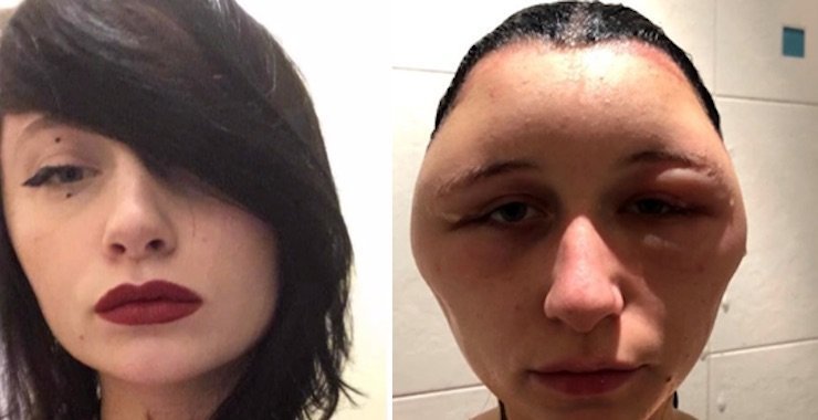 Аллергия на краску для волос превратила студентку в "лампочку"