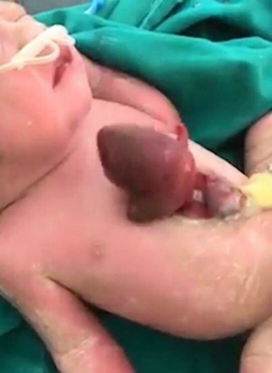 В Боливии девочка родилась с сердцем за пределами грудной клетки