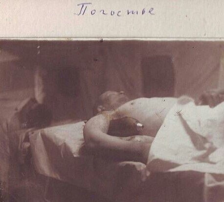 Красноармеец с пробившей плечо миной на операционном столе. Ленинградский фронт, 1942 г.