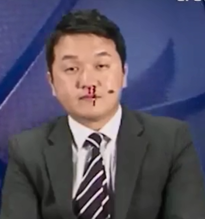 Репортер не ушел из эфира, несмотря на кровотечение из носа