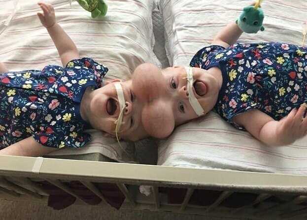 Сиамским близнецам со сросшимся мозгом врачи вернули полноценную жизнь