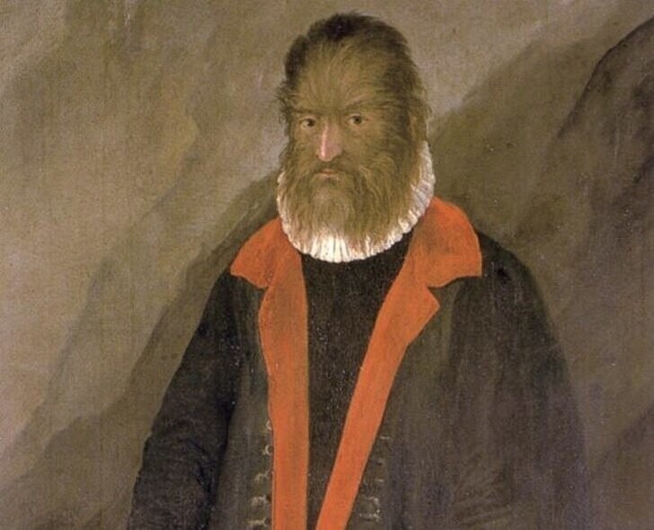 В 1537 году в Тенерифе, Канарские острова родился Петрус Гонсалвус.