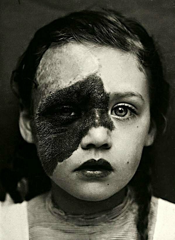 Девочка с меланоцитарным невусом на лице. Это темное, часто волосистое новообразование напоминает родимое пятно
