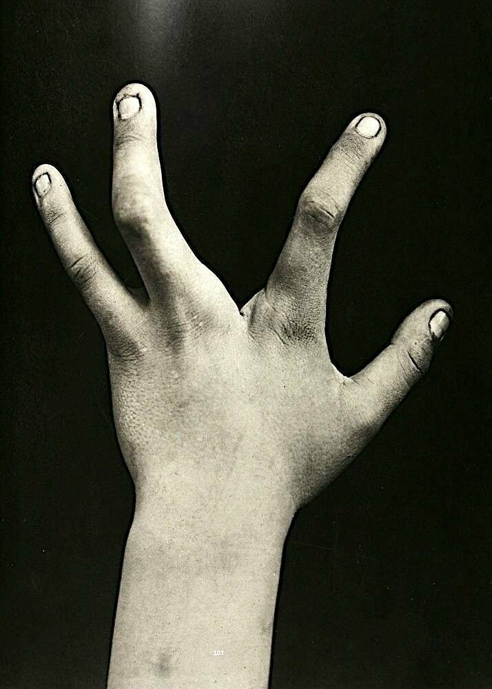 Олигодактилия руки - одна из самых редких врожденных аномалий верхних конечностей, и определяется как наличие менее пяти пальцев на руке
