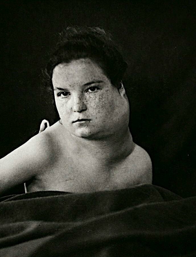 Мальчик, страдающий от гиберномы, редкой опухоли из жировой ткани на шее