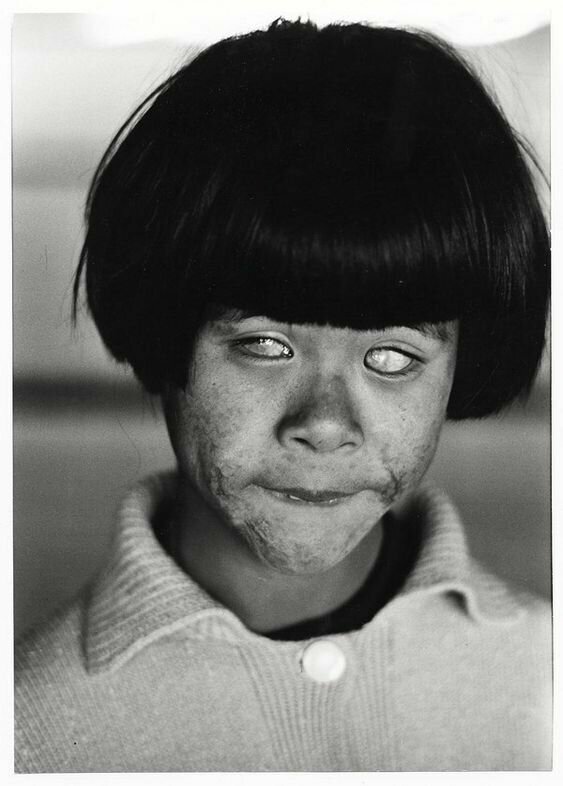 Девочка из Японии, после ядерной бомбардировки