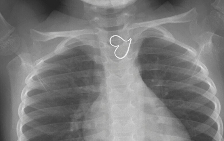 Трехлетняя девочка проглотила кулон, и удивила врачей "идеальным" рентгеном