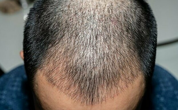 Пересадка волос опасна для здоровья
