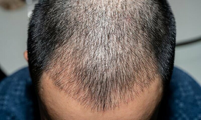 Пересадка волос опасна для здоровья