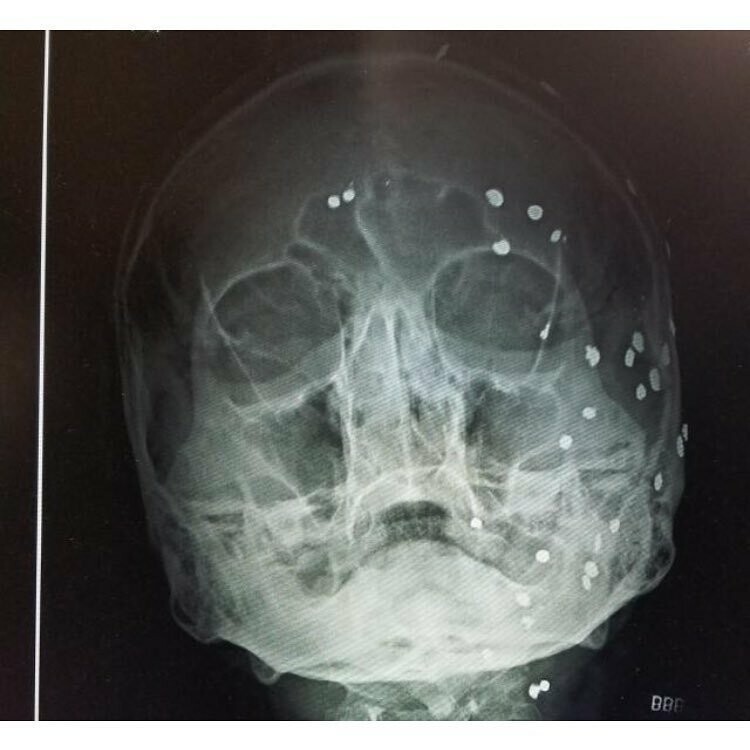 Пациент обратился в больницу с травмой носа. После снимка были обнаружены множественные вкрапления. Оказывается пациент уже 10 лет живет с ними. Это дробь, ему выстрелили ею в лицо.