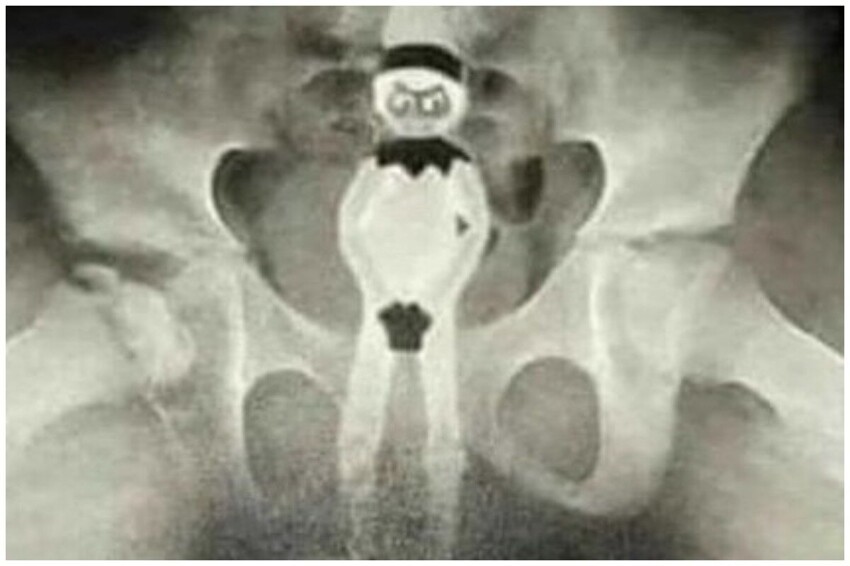 15 рентген снимков, демонстрирующих посторонние предметы внутри