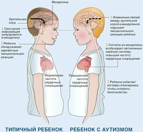 Одна из теорий - нарушения генетического отбора при ЭКО.