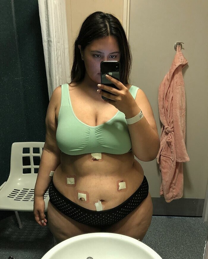 Похудевшая на 65 кг девушка показала откровенные фотографии "до и после"