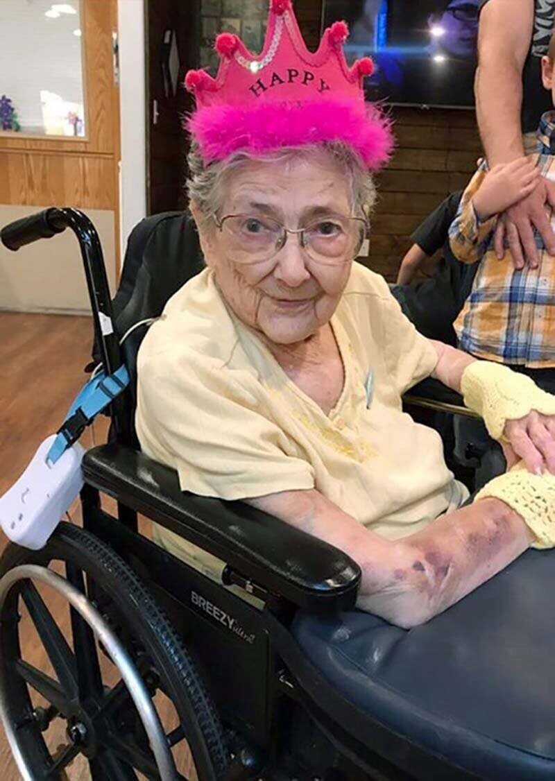 Женщина с зеркальным расположением органов смогла дожить до 99 лет