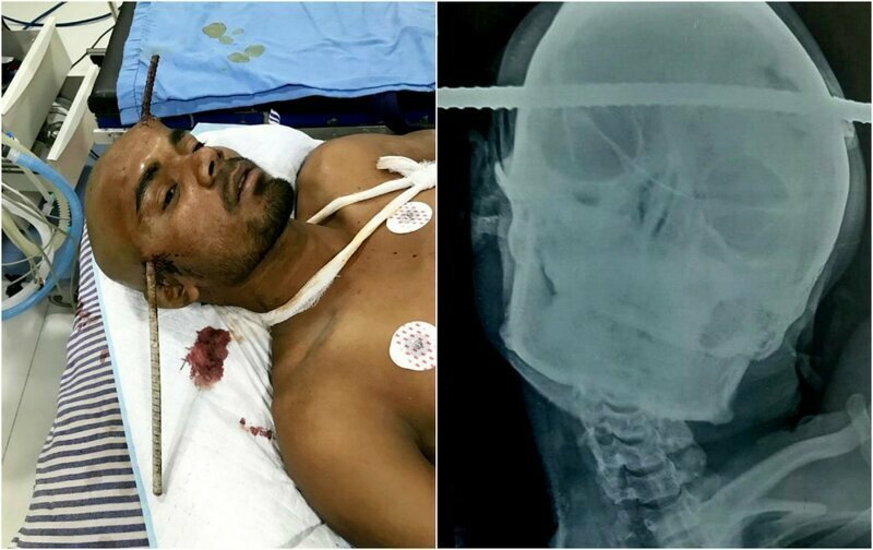 Индийский строитель проткнул голову арматурой и выжил