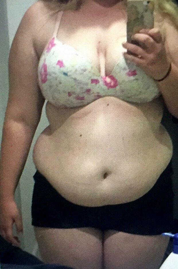 Девушка сбросила 63 кило, отказавшись от сахара