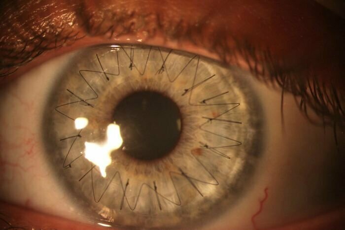 Глазное яблоко после трансплантации роговицы.