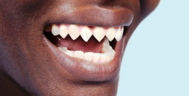 Сточенные зубы