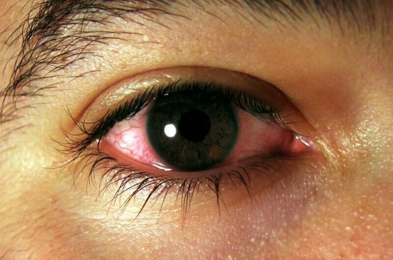 Основные причины покраснения глаз