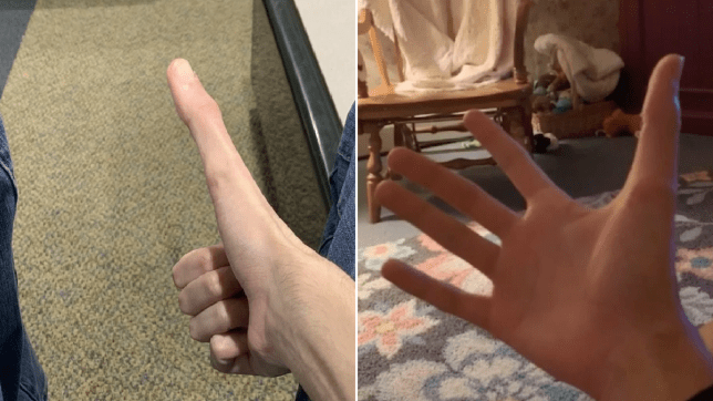 Американский студент прославился в сети благодаря своему большому пальцу