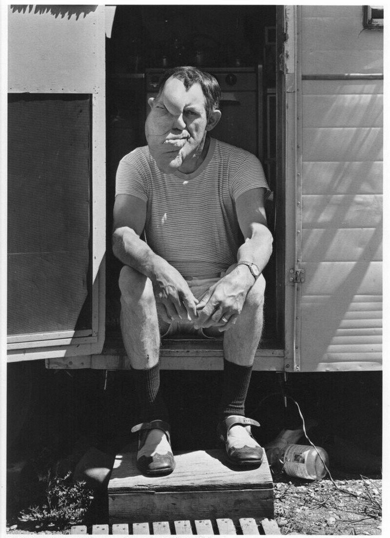 Боб Мелвин, человек с двумя лицами, Фарго, Северная Дакота, 1976.
