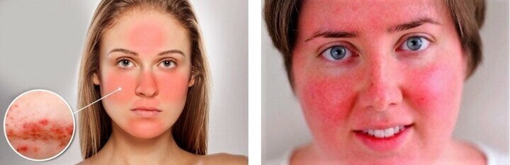 Патологические причины красноты кожи лица