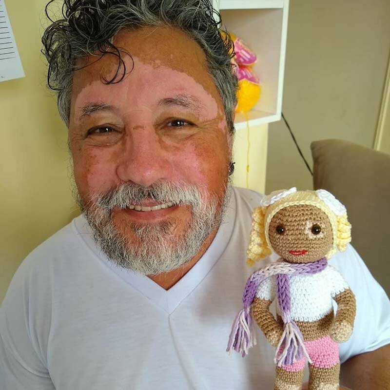 Дедушка вяжет куклы для поддержки детей с редким кожным заболеванием