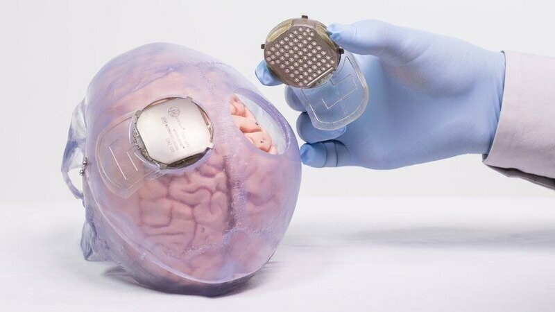 Схема имплантации датчиков в мозг