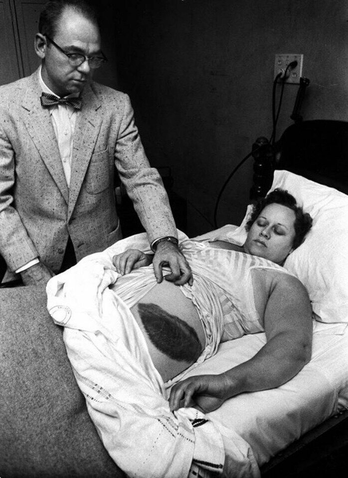 Энн Ходжес - женщина, в которую попал метеорит в 1954 году. След от попадания на боку Энн Ходжес. 