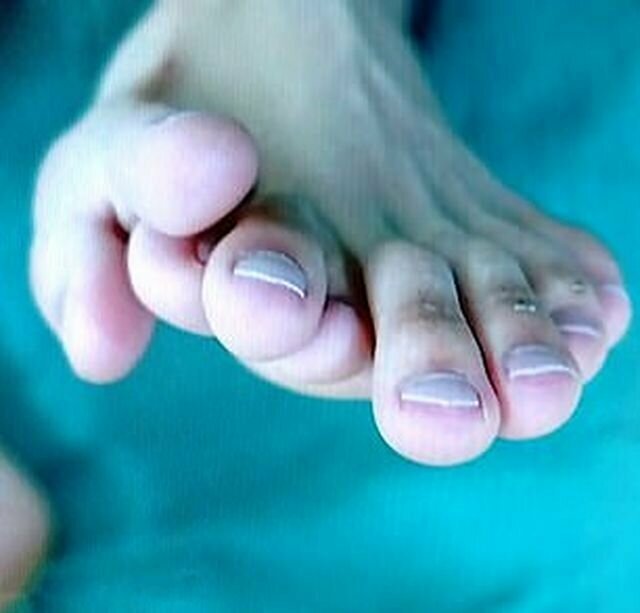 В Китае врачи прооперировали юношу с 9 пальцами на одной ноге