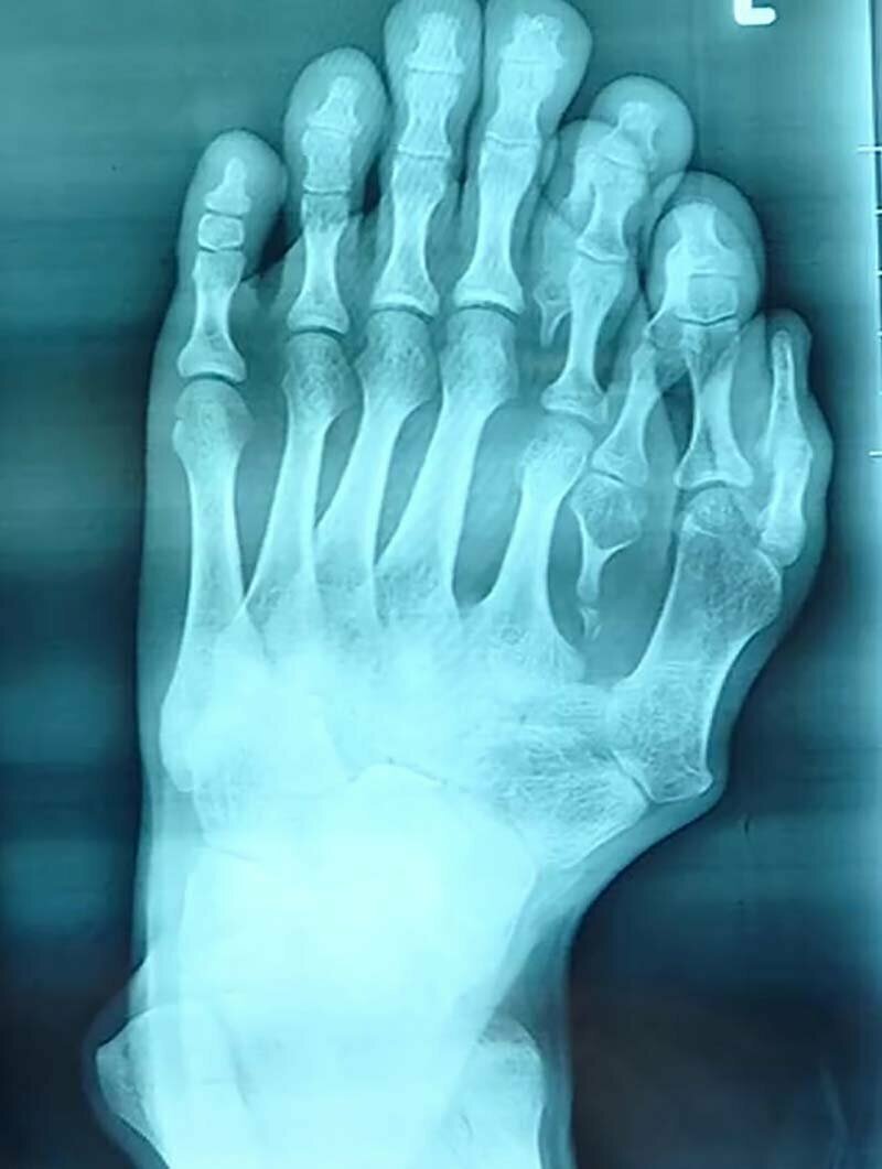 Сделанные предоперационные фотографии и рентгенограмма показали врачам степень тяжести деформации