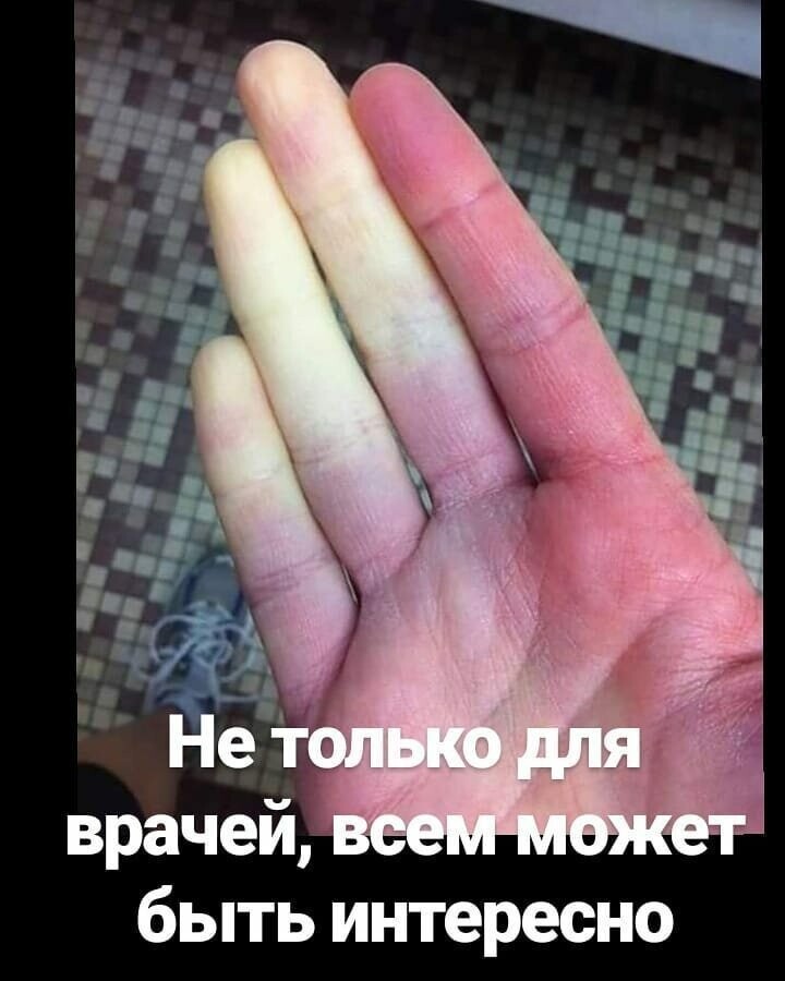Это ярковыраженный синдром Рейно