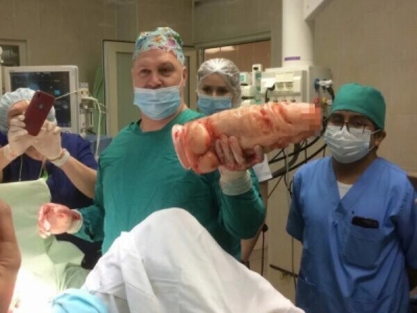 В Петербурге хирурги спасли мужчину от гигантского фаллоса