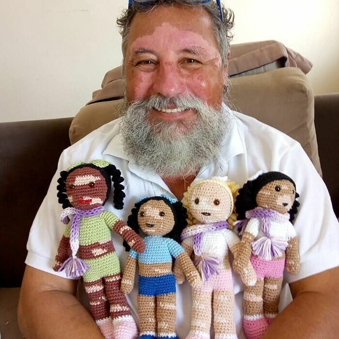 Дедушка с витилиго вяжет кукол для детей с таким же недугом