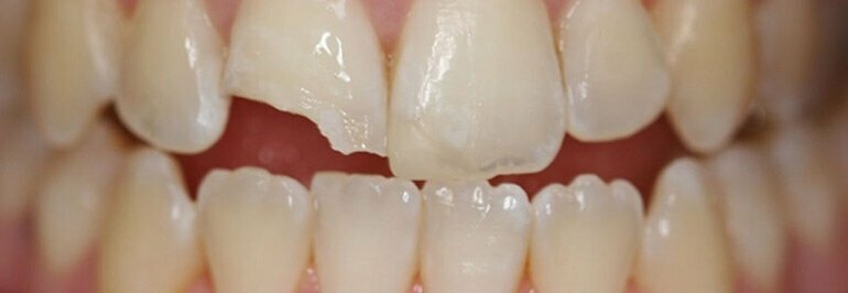 Причины, по которым у взрослых могут начать крошиться зубы