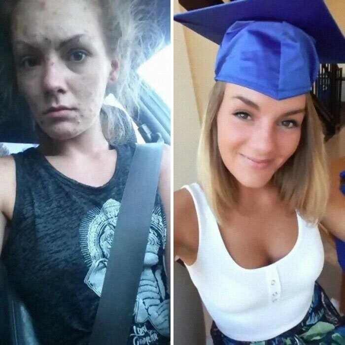 До и после: фотоистории людей, бросивших наркотики