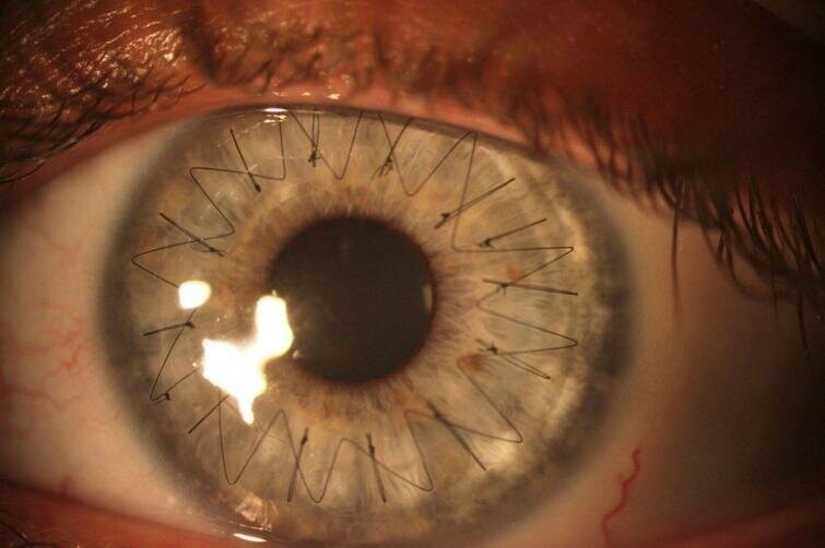 Глаз после пересадки роговицы