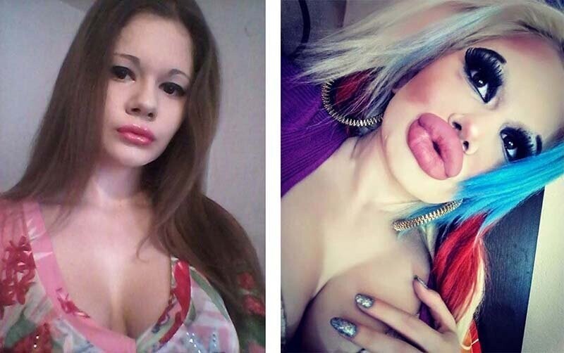 Девушка изменила размер своих губ с помощью 15 хирургических процедур