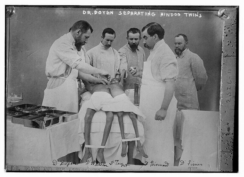 Первая успешная операция по разделению сиамских близнецов. Проводил Доктор Дойен в 1910-м году.