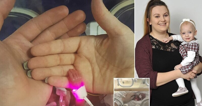 В Великобритании врачи спасли девочку, весившую при рождении 340 граммов