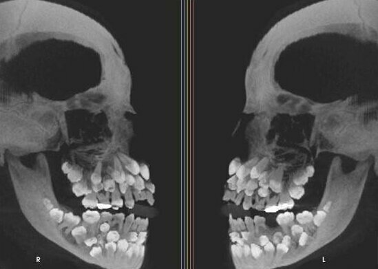 5. А это снимок человека с гипердонтией (аномалия числа зубов)