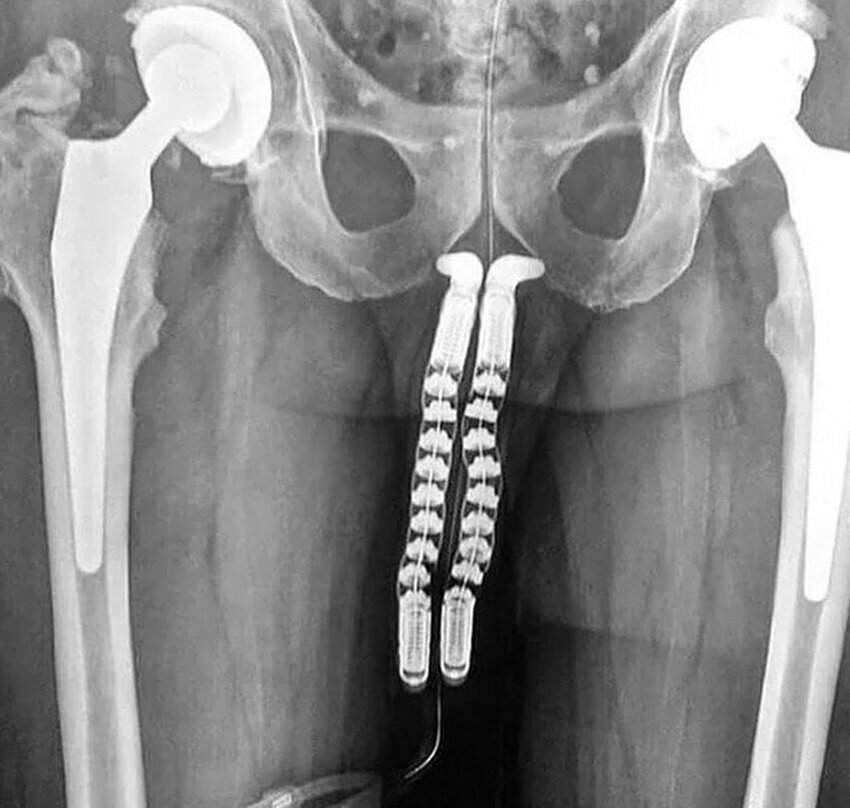 15. На фото процесс смены пола: вы видите рентген-снимок пациента на этапе трансплантации полового органа