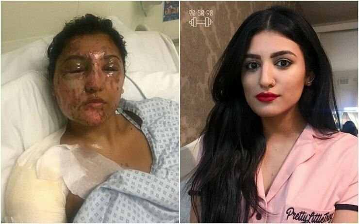 Девушка, которую облил кислотой бывший ухажер, показала лицо после пластики без макияжа